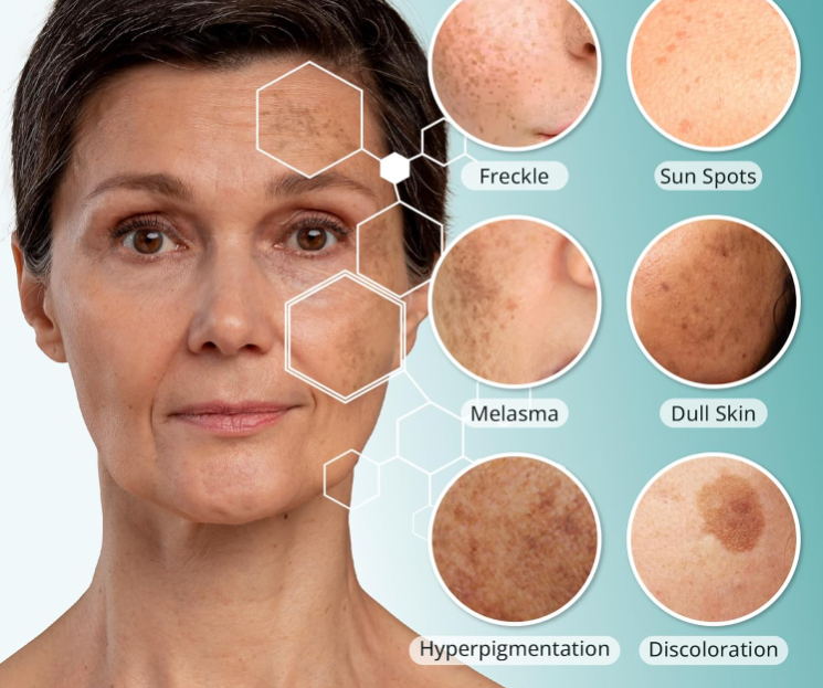 Prevention and Management of Melasma